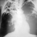 Case of Incidence of Pulmonary Tuberculosis